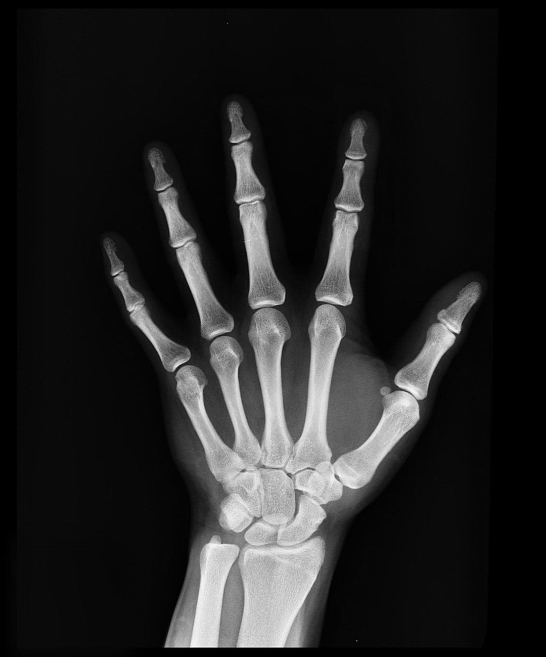 Frattura dello Scafoide: Sintomi, Diagnosi e Trattamenti